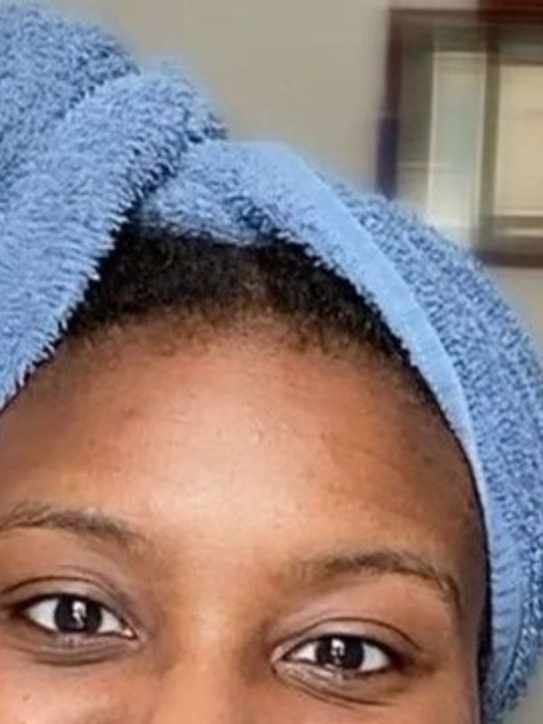 How-to-Get-Rid-of-Dandruff-in-Locs-Naturally